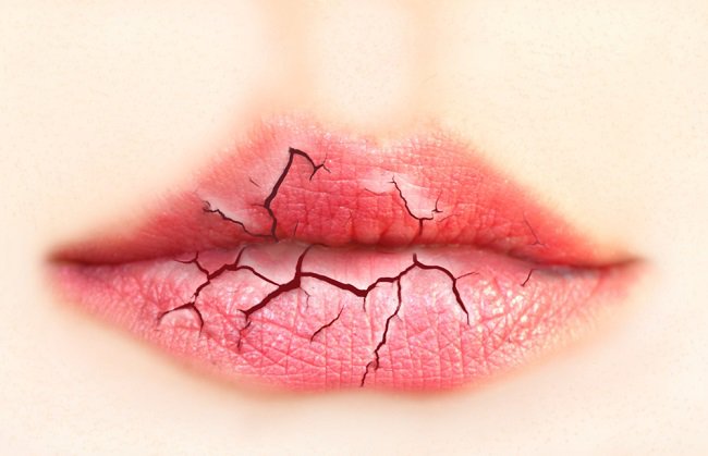 Ways to alleviate cracked lips
