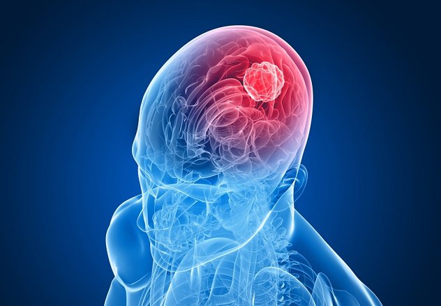 10 Early Signs of Brain Cancer