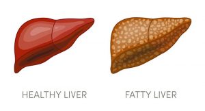 Healthy liver and diseased liver
