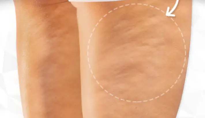 this is the presence of cellulite